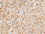 Immunohistochemistry of paraffin-embedded Human liver cancer tissue using HMGCLL1 Polyclonal Antibody at dilution of 1:60(×200)