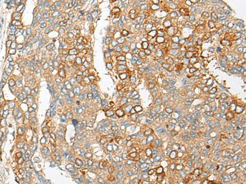 Immunohistochemistry of paraffin-embedded Human liver cancer tissue using PCDHGB5 Polyclonal Antibody at dilution of 1:35(×200)