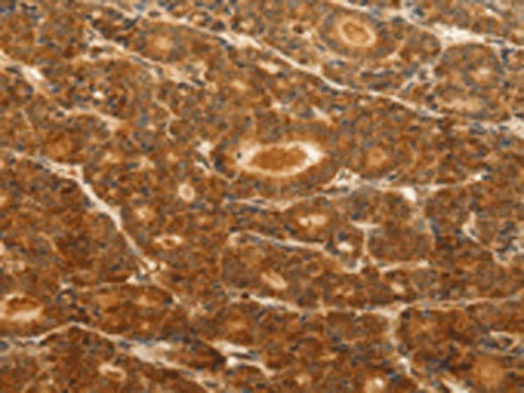 Immunohistochemistry of paraffin-embedded Human thyroid cancer tissue using CDH5 Polyclonal Antibody at dilution of 1:30(×200)