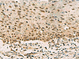 Immunohistochemistry of paraffin-embedded Human cervical cancer tissue using PHF5A Polyclonal Antibody at dilution of 1:90(×200)