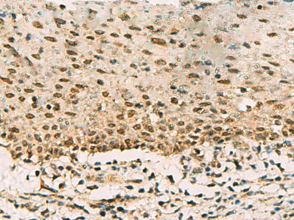 Immunohistochemistry of paraffin-embedded Human cervical cancer tissue using PHF5A Polyclonal Antibody at dilution of 1:90(×200)