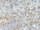 Immunohistochemistry of paraffin-embedded Human liver cancer tissue using COMMD9 Polyclonal Antibody at dilution of 1:55(×200)