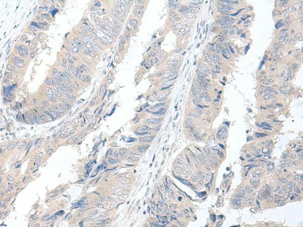Immunohistochemistry of paraffin-embedded Human colorectal cancer tissue using GBA2 Polyclonal Antibody at dilution of 1:55(×200)