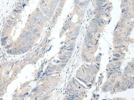 Immunohistochemistry of paraffin-embedded Human colorectal cancer tissue using GBA2 Polyclonal Antibody at dilution of 1:55(×200)