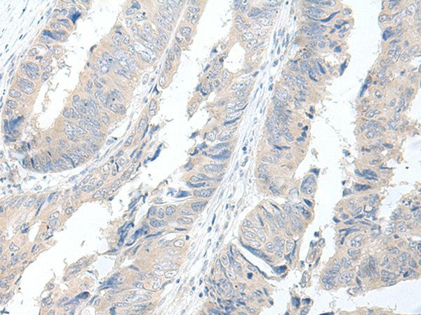 Immunohistochemistry of paraffin-embedded Human colorectal cancer tissue using GBA2 Polyclonal Antibody at dilution of 1:55(×200)