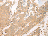 Immunohistochemistry of paraffin-embedded Human colorectal cancer tissue using ASIC3 Polyclonal Antibody at dilution of 1:40(×200)