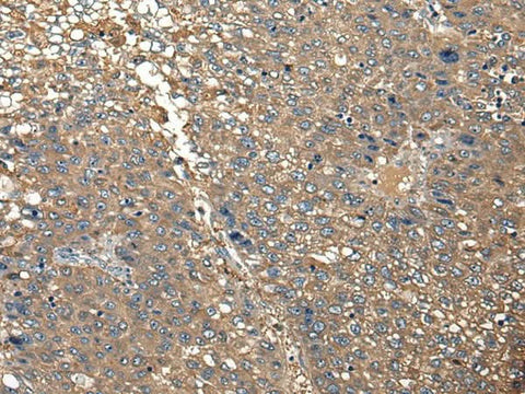 Immunohistochemistry of paraffin-embedded Human liver cancer tissue using DGKI Polyclonal Antibody at dilution of 1:30(×200)
