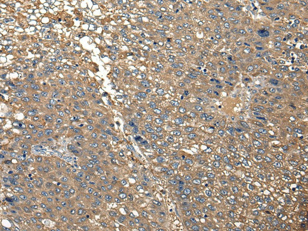 Immunohistochemistry of paraffin-embedded Human liver cancer tissue using DGKI Polyclonal Antibody at dilution of 1:30(×200)