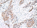 Immunohistochemistry of paraffin-embedded Human esophagus cancer tissue using POLD2 Polyclonal Antibody at dilution of 1:95(×200)