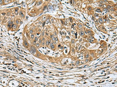 Immunohistochemistry of paraffin-embedded Human esophagus cancer tissue using EARS2 Polyclonal Antibody at dilution of 1:30(×200)