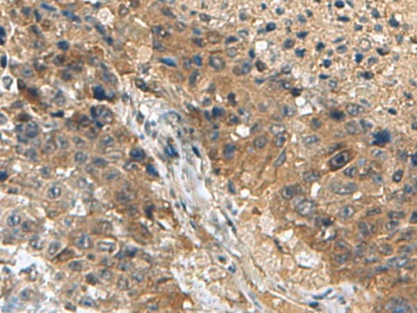 Immunohistochemistry of paraffin-embedded Human liver cancer tissue using TPD52L3 Polyclonal Antibody at dilution of 1:140(×200)