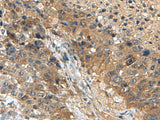 Immunohistochemistry of paraffin-embedded Human liver cancer tissue using TPD52L3 Polyclonal Antibody at dilution of 1:140(×200)