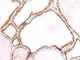 Immunohistochemistry of paraffin-embedded Human thyroid cancer tissue using LMCD1 Polyclonal Antibody at dilution of 1:80(×200)