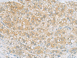 Immunohistochemistry of paraffin-embedded Human liver cancer tissue using EPCAM Polyclonal Antibody at dilution of 1:60(×200)
