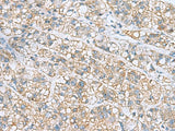 Immunohistochemistry of paraffin-embedded Human liver cancer tissue using NANP Polyclonal Antibody at dilution of 1:50(×200)
