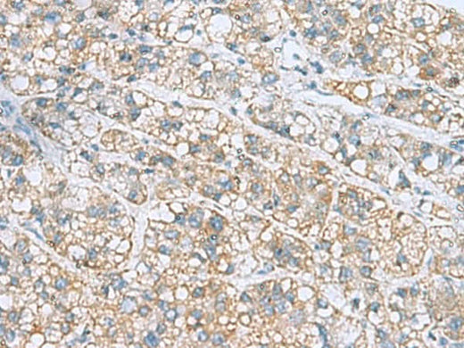 Immunohistochemistry of paraffin-embedded Human liver cancer tissue using NANP Polyclonal Antibody at dilution of 1:50(×200)