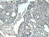 Immunohistochemistry of paraffin-embedded Human colorectal cancer tissue using SLC35F6 Polyclonal Antibody at dilution of 1:95(×200)