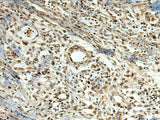 Immunohistochemistry of paraffin-embedded Human breast cancer tissue using MLF1 Polyclonal Antibody at dilution of 1:105(×200)