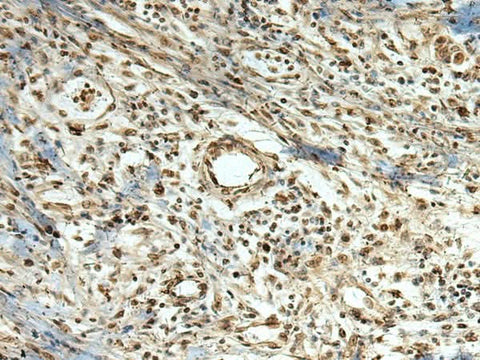 Immunohistochemistry of paraffin-embedded Human breast cancer tissue using MLF1 Polyclonal Antibody at dilution of 1:105(×200)