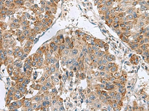 Immunohistochemistry of paraffin-embedded Human liver cancer tissue using NFS1 Polyclonal Antibody at dilution of 1:50(×200)