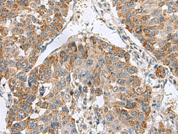 Immunohistochemistry of paraffin-embedded Human liver cancer tissue using NFS1 Polyclonal Antibody at dilution of 1:50(×200)