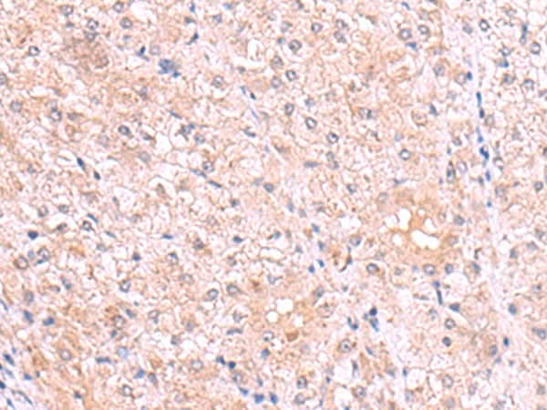 Immunohistochemistry of paraffin-embedded Human liver cancer tissue using PISD Polyclonal Antibody at dilution of 1:80(×200)