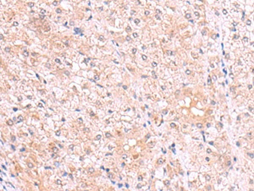 Immunohistochemistry of paraffin-embedded Human liver cancer tissue using PISD Polyclonal Antibody at dilution of 1:80(×200)
