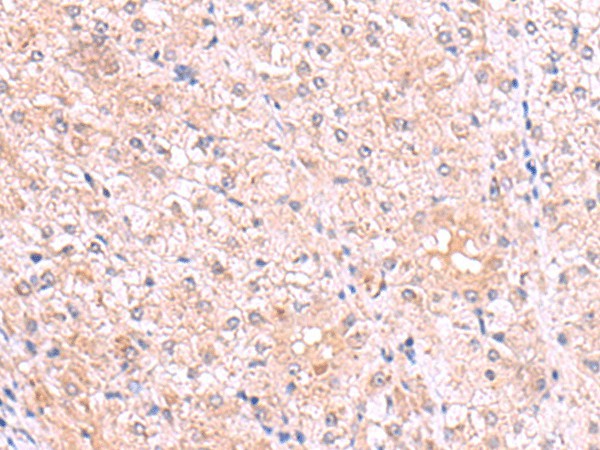 Immunohistochemistry of paraffin-embedded Human liver cancer tissue using PISD Polyclonal Antibody at dilution of 1:80(×200)