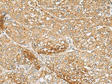 Immunohistochemistry of paraffin-embedded Human liver cancer tissue using C1orf112 Polyclonal Antibody at dilution of 1:110(×200)