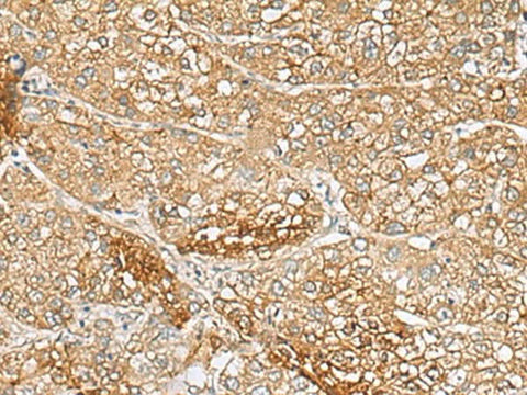 Immunohistochemistry of paraffin-embedded Human liver cancer tissue using C1orf112 Polyclonal Antibody at dilution of 1:110(×200)