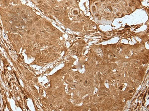 Immunohistochemistry of paraffin-embedded Human esophagus cancer tissue using LIPG Polyclonal Antibody at dilution of 1:50(×200)