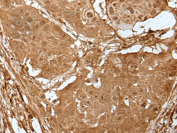 Immunohistochemistry of paraffin-embedded Human esophagus cancer tissue using LIPG Polyclonal Antibody at dilution of 1:50(×200)