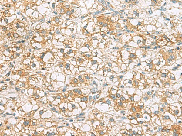 Immunohistochemistry of paraffin-embedded Human liver cancer tissue using TLE6 Polyclonal Antibody at dilution of 1:75(×200)