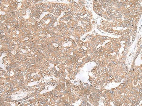 Immunohistochemistry of paraffin-embedded Human liver cancer tissue using PTP4A3 Polyclonal Antibody at dilution of 1:40(×200)