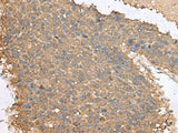 Immunohistochemistry of paraffin-embedded Human liver cancer tissue using FAM19A4 Polyclonal Antibody at dilution of 1:65(×200)