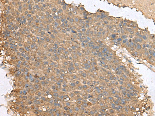 Immunohistochemistry of paraffin-embedded Human liver cancer tissue using FAM19A4 Polyclonal Antibody at dilution of 1:65(×200)