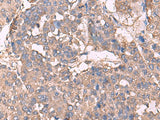 Immunohistochemistry of paraffin-embedded Human liver cancer tissue using KCNN2 Polyclonal Antibody at dilution of 1:30(×200)