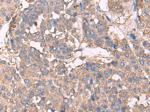 Immunohistochemistry of paraffin-embedded Human liver cancer tissue using KCNN2 Polyclonal Antibody at dilution of 1:30(×200)