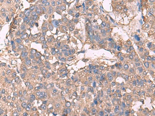 Immunohistochemistry of paraffin-embedded Human liver cancer tissue using KCNN2 Polyclonal Antibody at dilution of 1:30(×200)