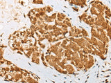 Immunohistochemistry of paraffin-embedded Human thyroid cancer tissue using ATN1 Polyclonal Antibody at dilution of 1:50(×200)