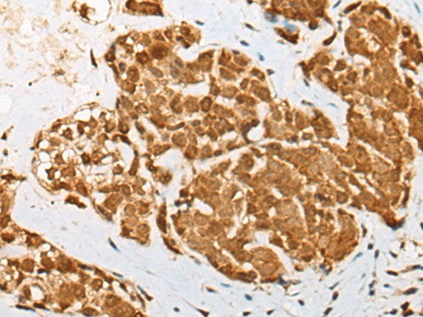 Immunohistochemistry of paraffin-embedded Human thyroid cancer tissue using ATN1 Polyclonal Antibody at dilution of 1:50(×200)
