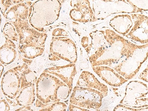 Immunohistochemistry of paraffin-embedded Human thyroid cancer tissue using RBM19 Polyclonal Antibody at dilution of 1:30(×200)