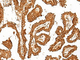 Immunohistochemistry of paraffin-embedded Human thyroid cancer tissue using GBP4 Polyclonal Antibody at dilution of 1:45(×200)