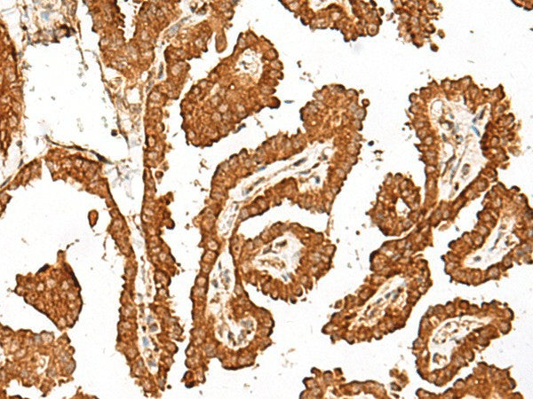 Immunohistochemistry of paraffin-embedded Human thyroid cancer tissue using GBP4 Polyclonal Antibody at dilution of 1:45(×200)