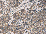 Immunohistochemistry of paraffin-embedded Human colorectal cancer tissue using MAPKAPK3 Polyclonal Antibody at dilution of 1:95(×200)