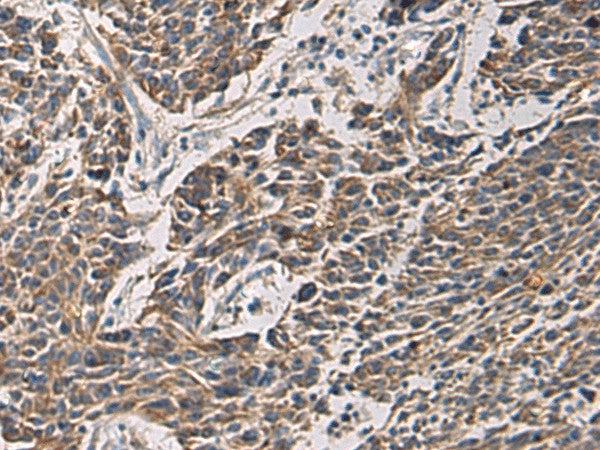 Immunohistochemistry of paraffin-embedded Human colorectal cancer tissue using MAPKAPK3 Polyclonal Antibody at dilution of 1:95(×200)