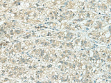 Immunohistochemistry of paraffin-embedded Human liver cancer tissue using TENT5C Polyclonal Antibody at dilution of 1:110(×200)
