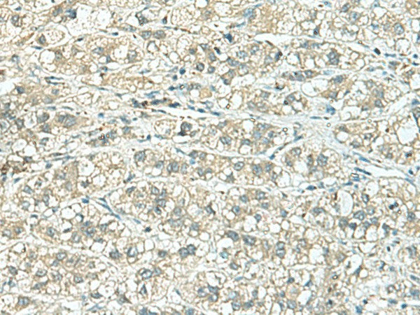 Immunohistochemistry of paraffin-embedded Human liver cancer tissue using TENT5C Polyclonal Antibody at dilution of 1:110(×200)