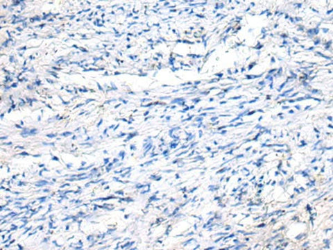 Immunohistochemistry of paraffin-embedded Human ovarian cancer tissue using FGF11 Polyclonal Antibody at dilution of 1:50(×200)