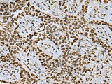 Immunohistochemistry of paraffin-embedded Human ovarian cancer tissue using MYEF2 Polyclonal Antibody at dilution of 1:55(×200)